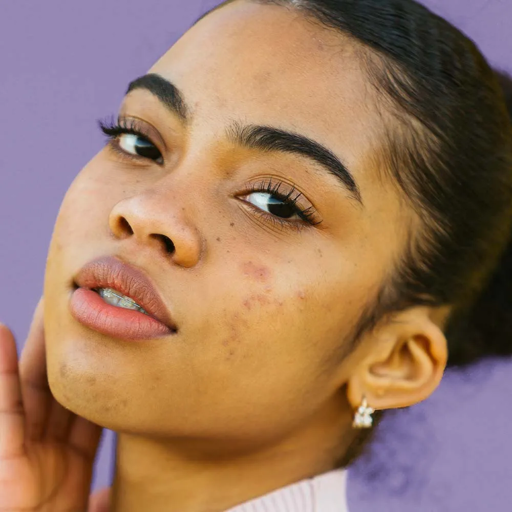 Clearskin Blemish Clearing AHA Treatment