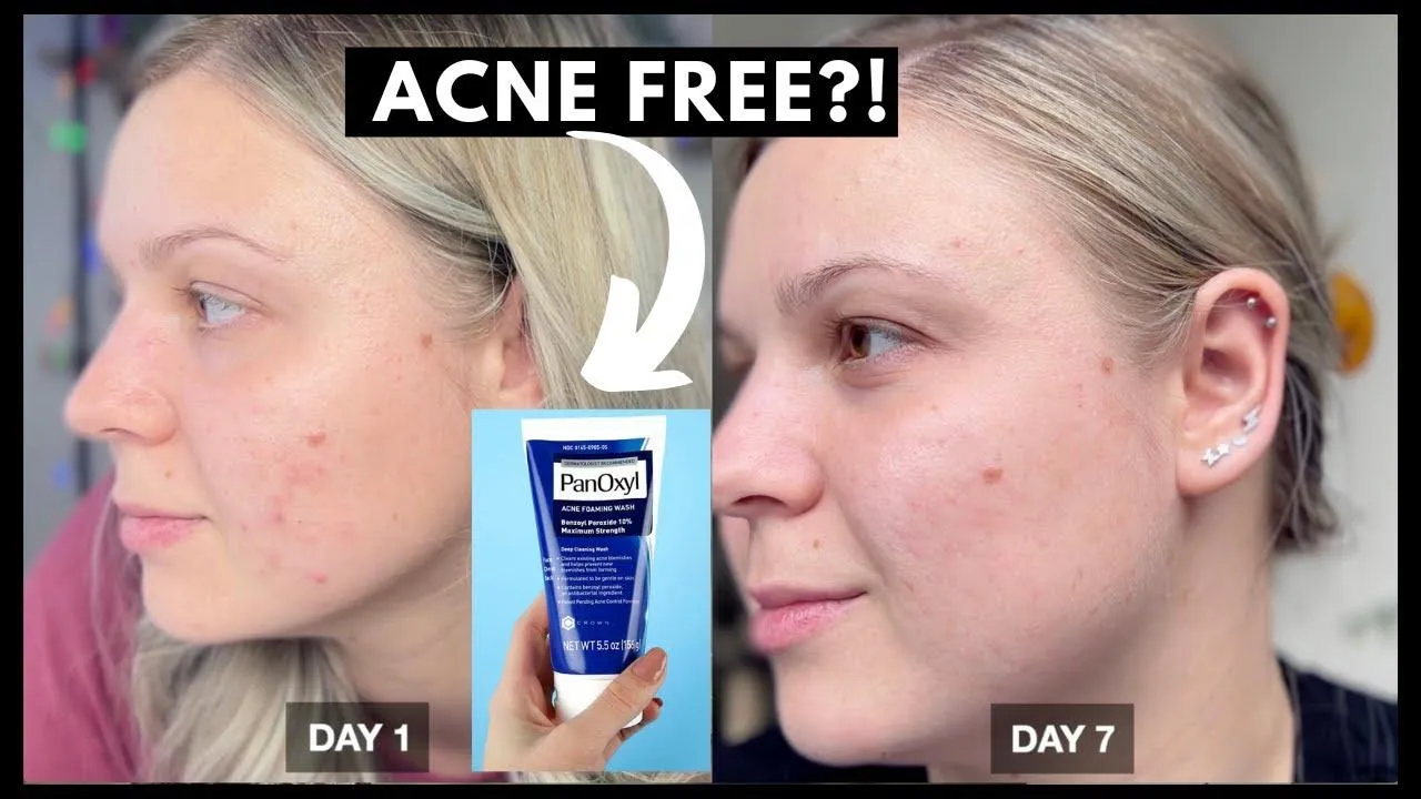 Panoxyl Acne Foaming Wash 10% Benzoyl Peroxide (new package)