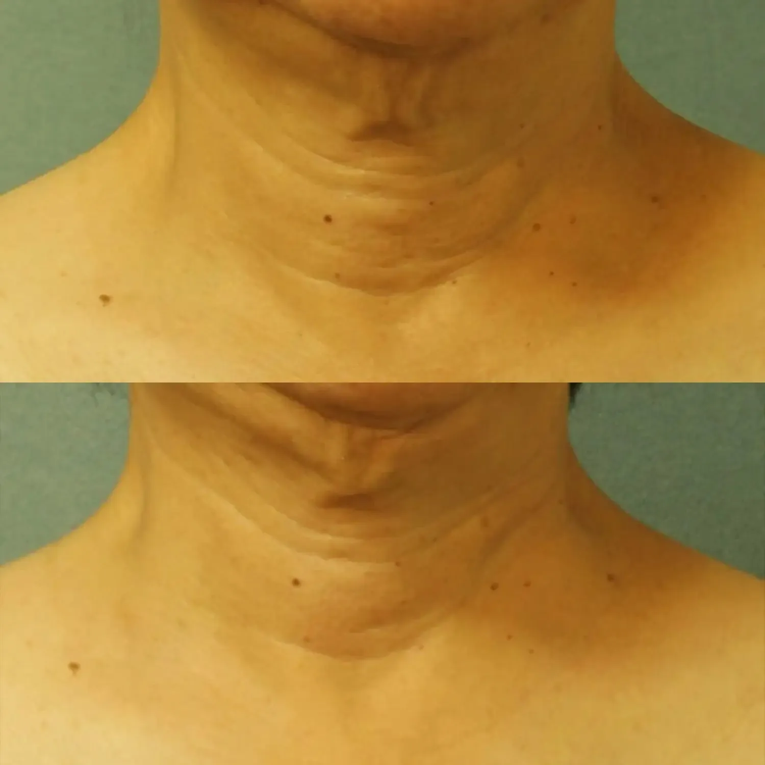 Perricone MD Cold Plasma Plus Neck Chest SPF 25