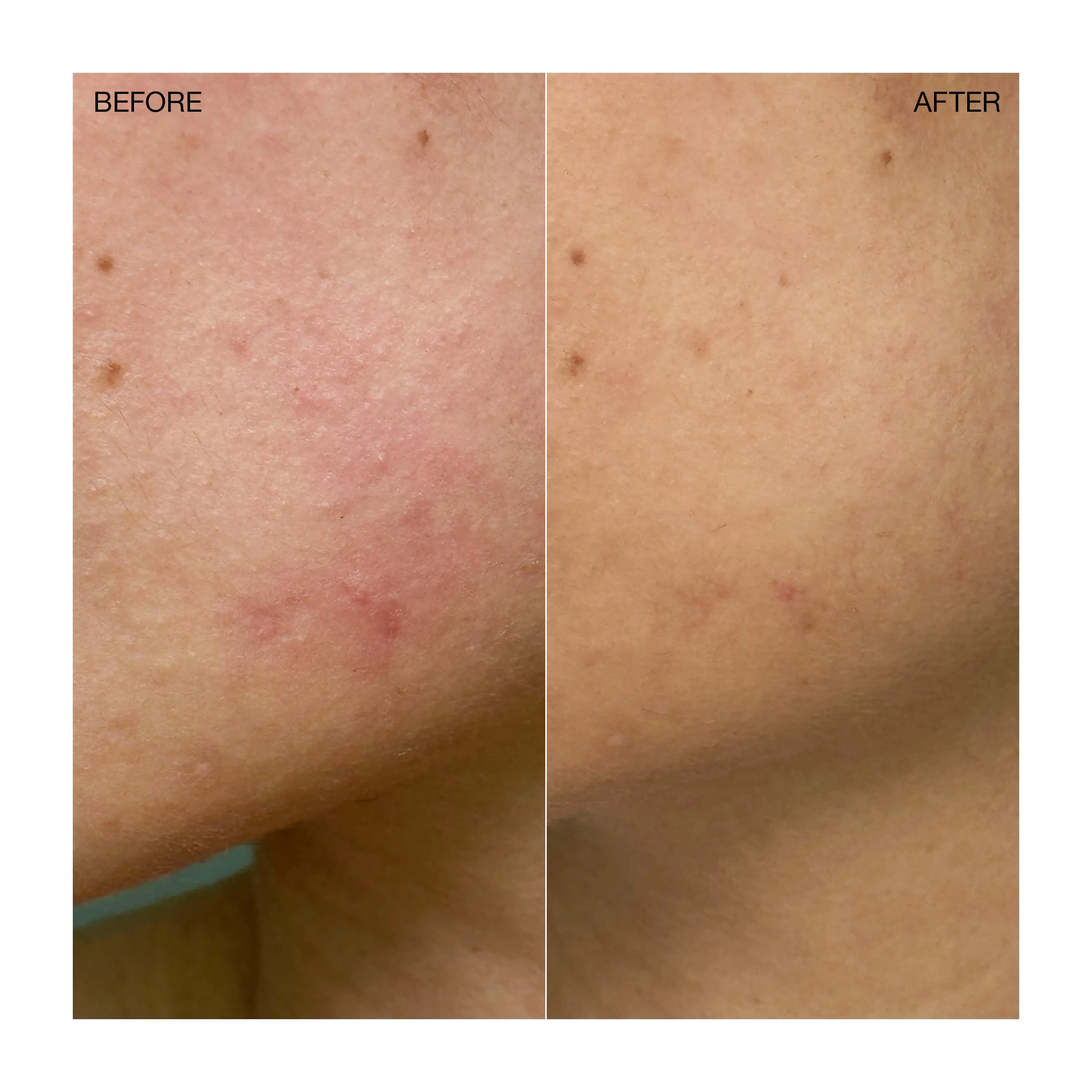 Targeted Blemish Treatment* Ogee