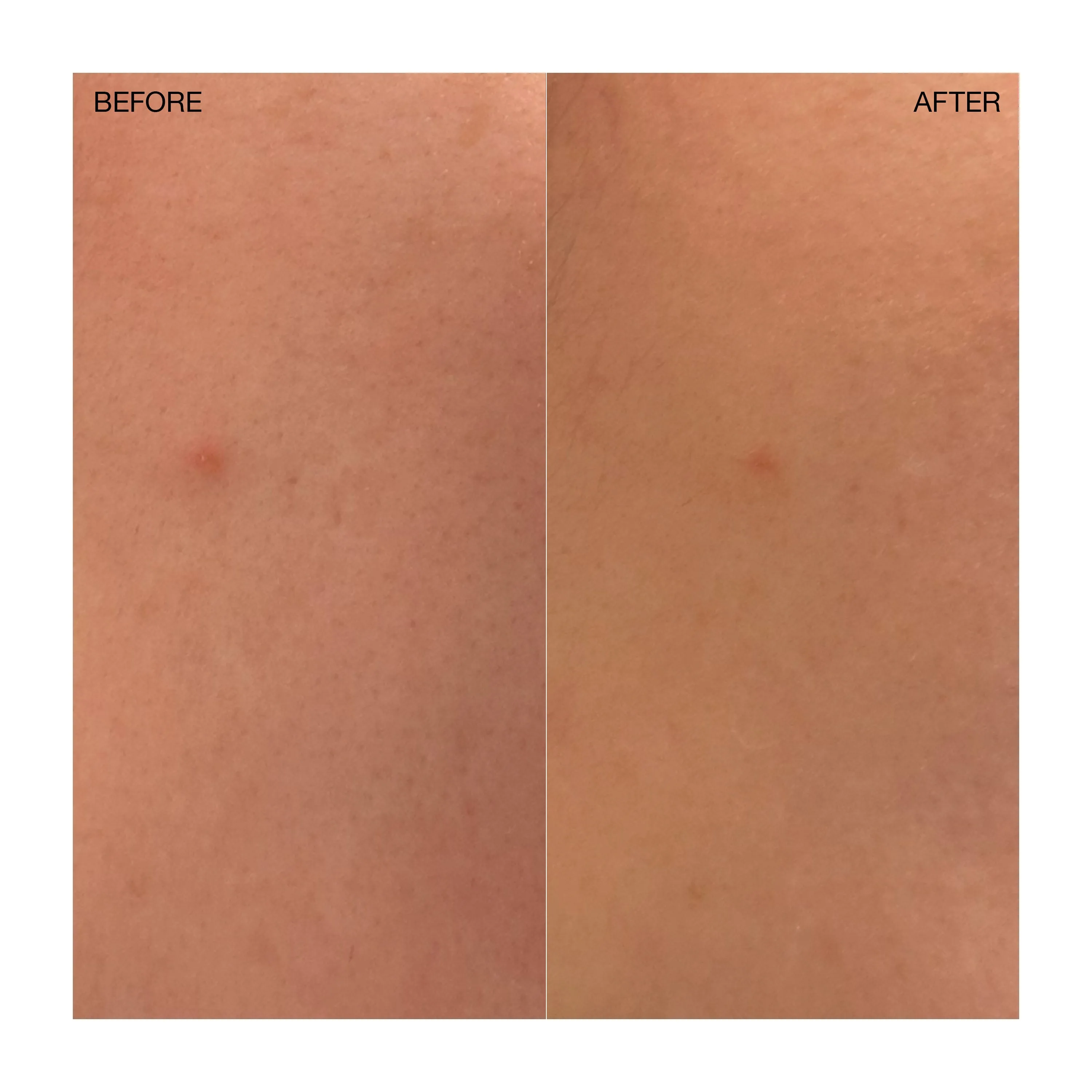 Targeted Blemish Treatment Ogee